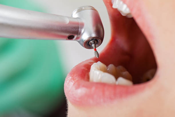Best Emergency Wisdom Teeth Removal in Mount Olive, AL